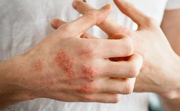Tìm Hiểu Về Bệnh Chàm, Nguyên Nhân, Pháp Trị Trong YHCT