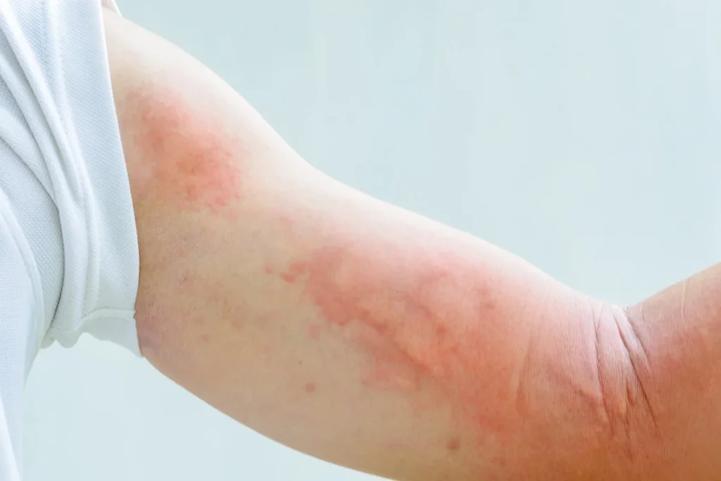 Tìm Hiểu, Khám Phá Về Bệnh Mề Đay Trong YHCT