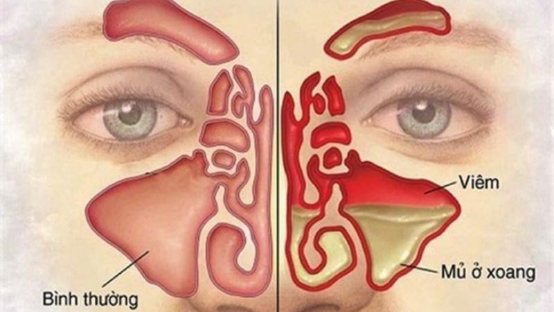 Viêm Xoang Mạn Tính Và 7 Huyệt Đạo Châm Cứu Hiệu Quả Trong YHCT